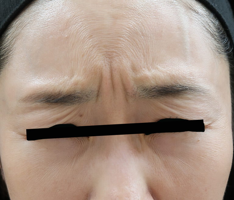 眉間施術前