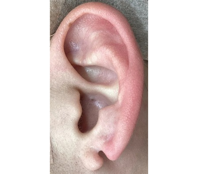 Ｚ形成術手術前