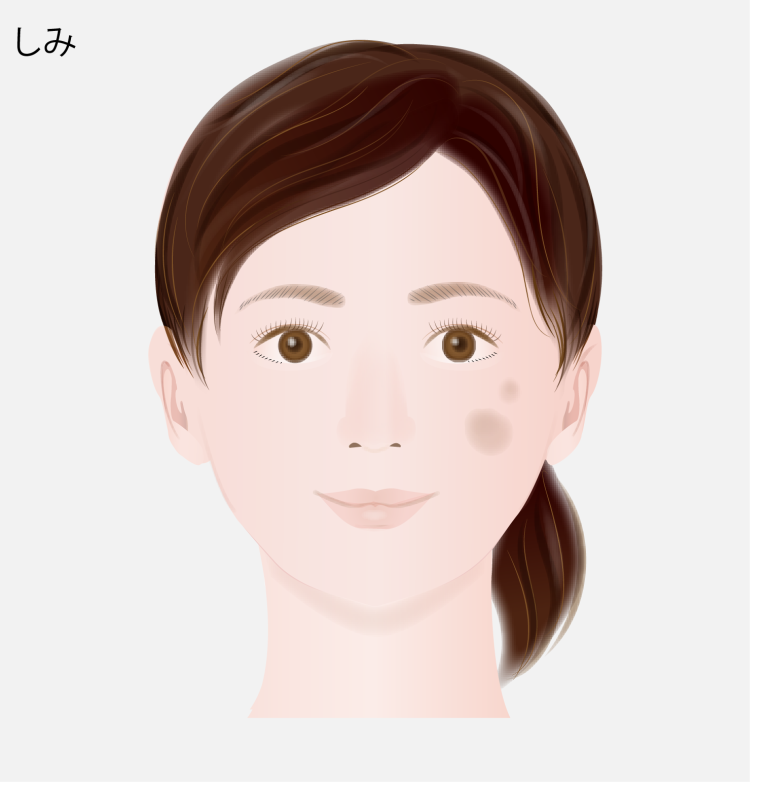 老人性色素斑（ろうじんせいしきそはん）