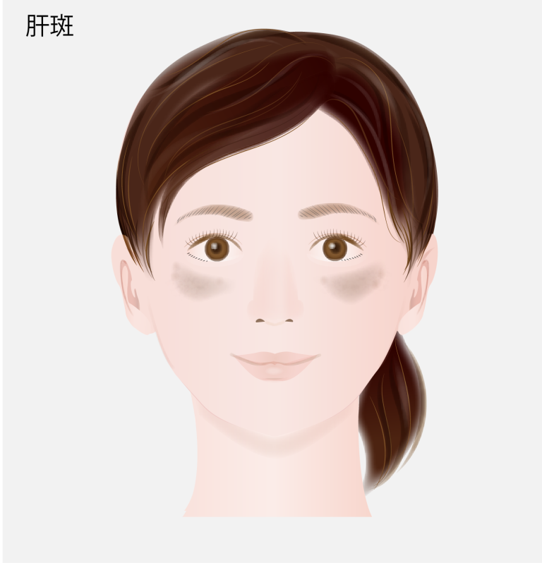 肝斑（かんぱん）