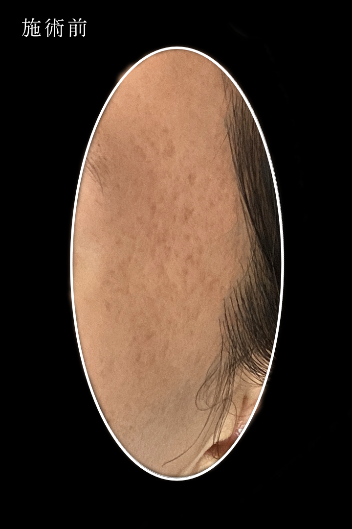 ジュベルックBLS症例 N井様 術前