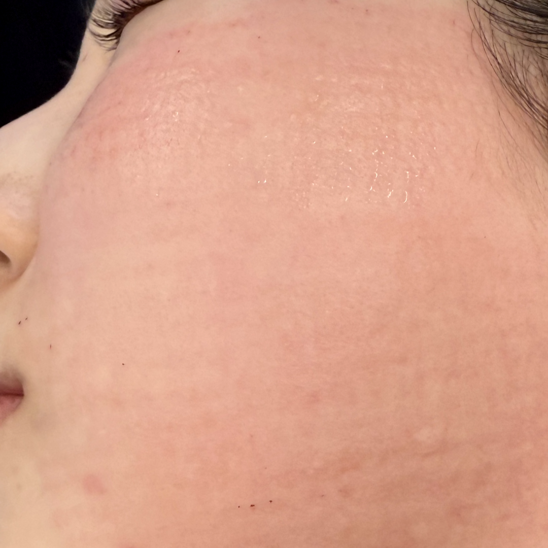 BLS症例_I田様_施術直後