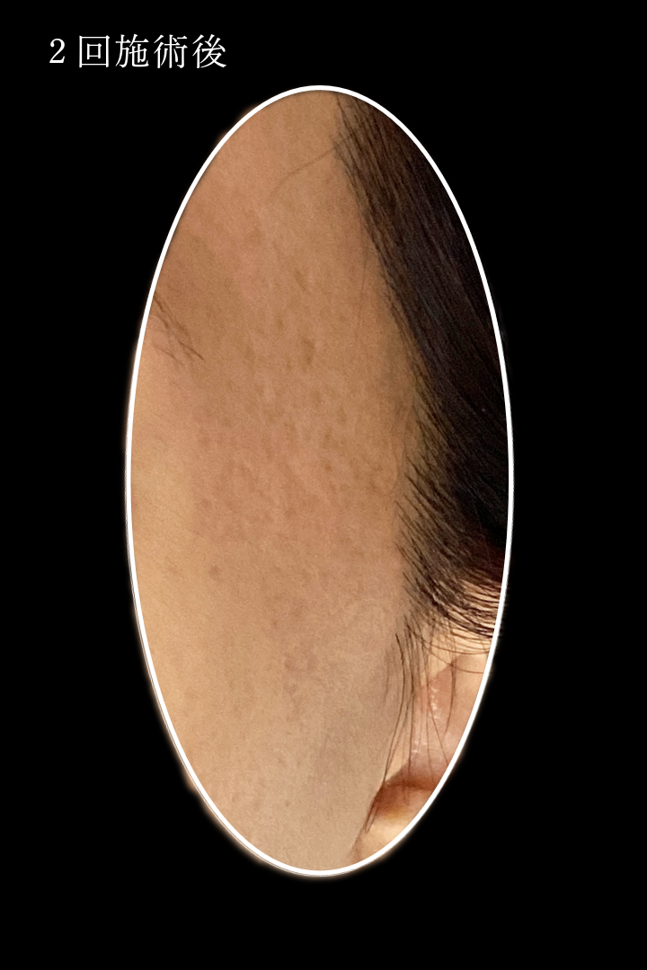 ジュベルックBLS症例 N井様 2回術後