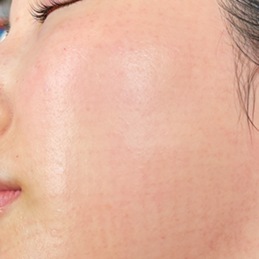 BLS症例_I田様_施術7時間後