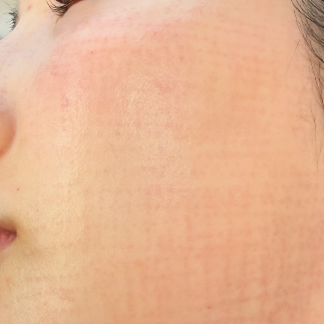 BLS症例_I田様_施術4時間後