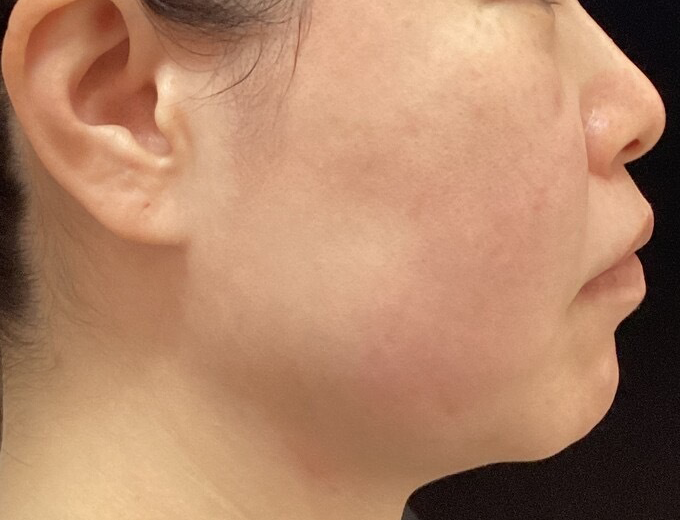 横顔 施術後